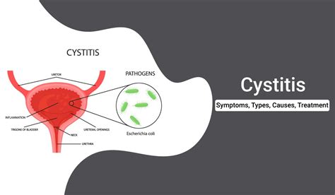  Seeking Professional Help: Next Steps for Persistent Cystitis Treatment Dreams