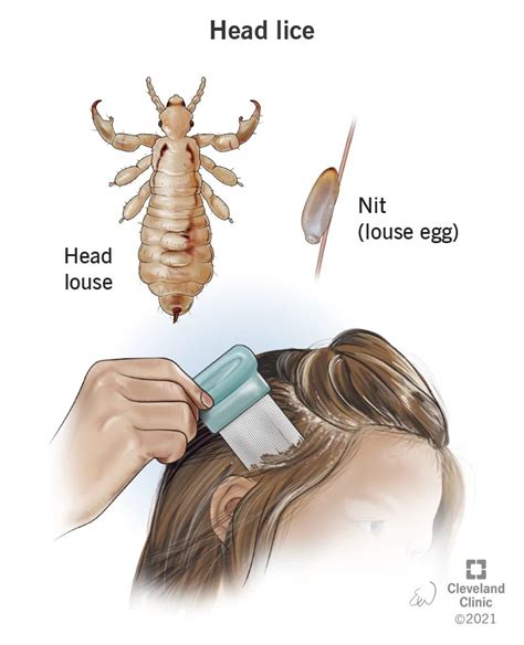 A Curious Case: Gaining Insight into the Phenomenon of Lice Infestation in Children