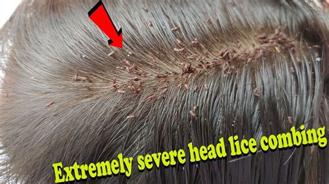 A Nightmare Come True: The Intense Battle Against Severe Lice Infestation