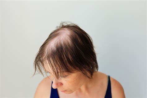 A Startling Discovery: Unanticipated Hair Loss