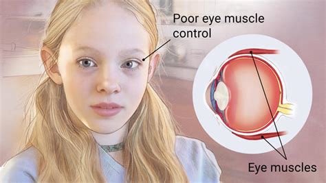 A Unique Perspective: How a Young Mind Sees Strabismus