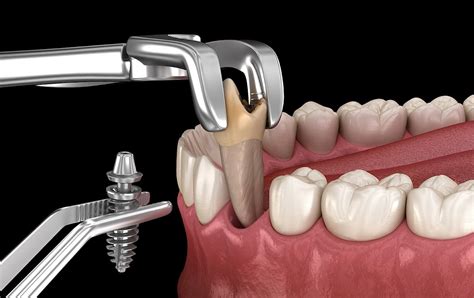 Advancements in Dentistry: The Promise of Non-Bloody and Painless Tooth Extractions