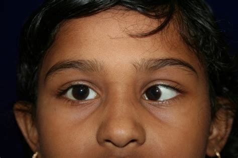 An extraordinary account of a young child's early experience with strabismus