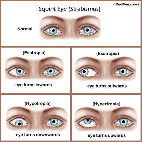 Analyzing the Impact of Personal Experiences on Dreams about Strabismus