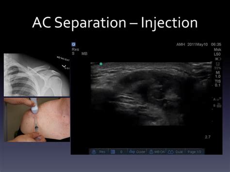 Analyzing the Placement of Injections on the Upper Limb in Dream Interpretation