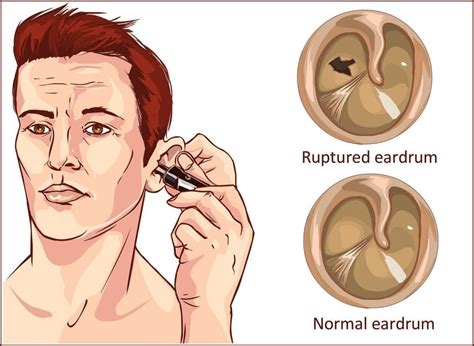 Are Your Earbuds Causing Damage to Your Tympanic Membrane?