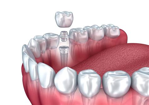 Causes and Triggers of Dreams about Losing an Implanted Dental Element