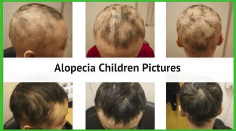 Causes and Types of Hair Loss in Children