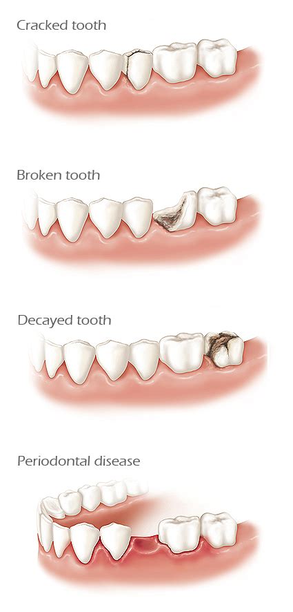 Causes of Tooth Loss