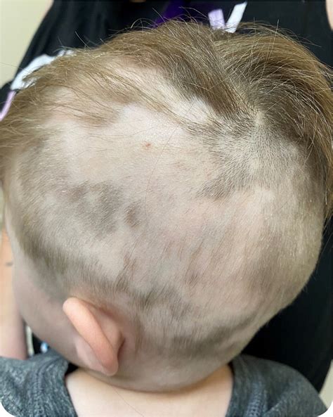 Common Reasons for Hair Loss in Children