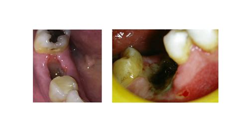 Conquering Fear: Decoding the Message Behind a Dark Tooth Dislodging