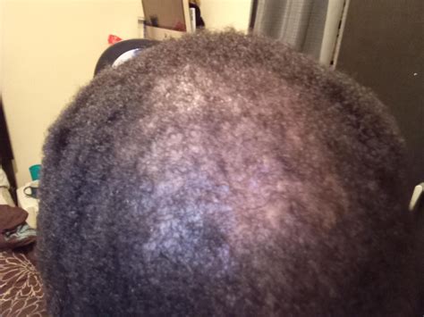 Could it be Alopecia?