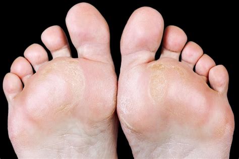 Decoding Dreams of Calluses: Are Your Feet Trying to Communicate Something?