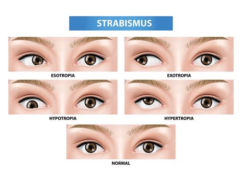 Decoding the Enigma: Understanding the Essence of Strabismus in Dreams