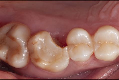 Delving into the Cryptic Significance of Dreaming about a Hematogenesis-Devoid Fractured Molar