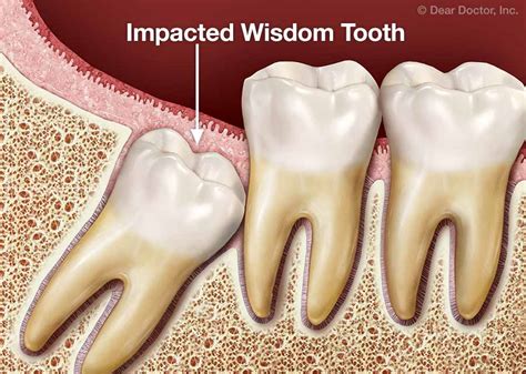 Discovering the Meaning Behind a Wisdom Tooth Falling Out and its Potential Impact on Relationships