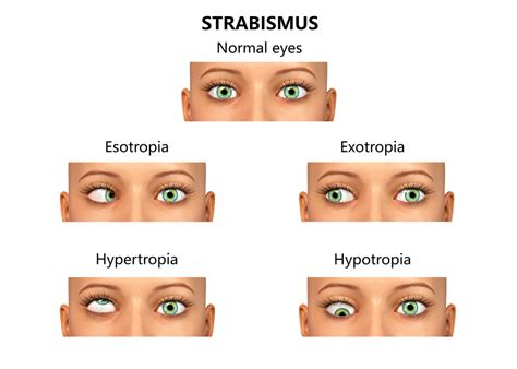 Discovering the Underlying Causes and Risk Factors of Strabismus