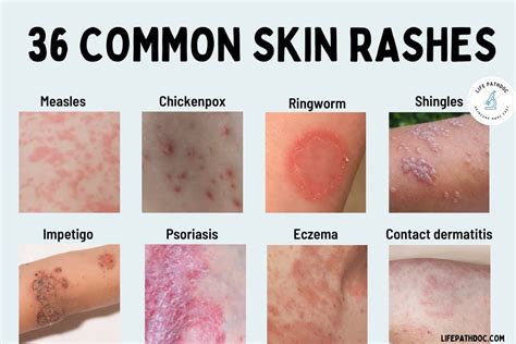 Dispelling Common Misconceptions about Childhood Skin Rashes