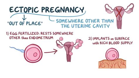 Ectopic Pregnancy: A Possible Explanation for Vaginal Bleeding