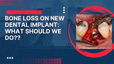 Embracing the Lessons and Growth Opportunities from Dreams about Losing a Dental Implant