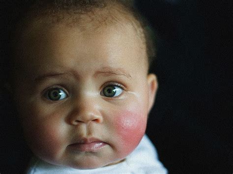 Environmental Triggers for Rosy Cheeks in Children