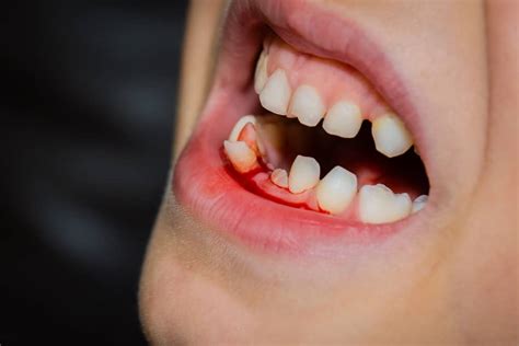 Examining the Psychological Explanations of Dreaming about Bloodied Teeth