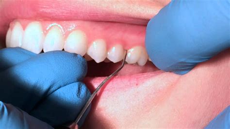 Exploring Dental Health and Tooth Loss in Dreams