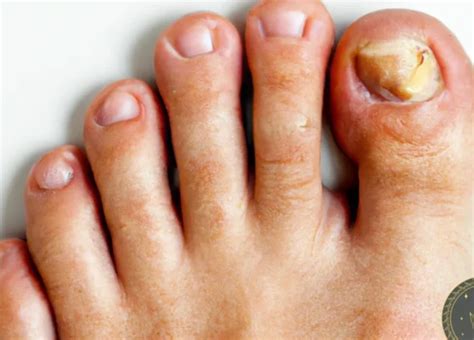 Exploring the Possible Interpretations of Dreaming About Damaged Toenails