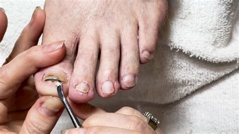 Exploring the Potential Messages or Warnings Behind Dreams About Damaged Toenails