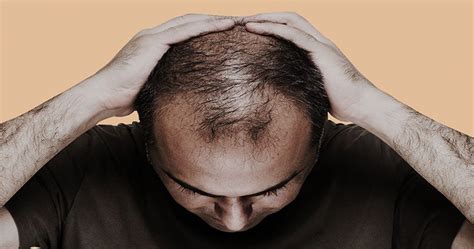 Exploring the Psychological Implications of a Bald Spot in Dream Interpretation