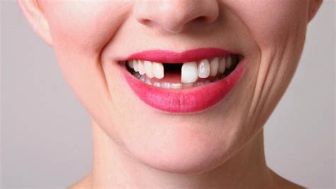 Exploring the Symbolism of a Surprisingly Relieved Upper Tooth Loss