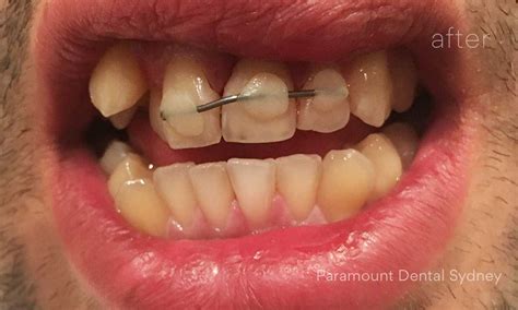 From Vision to Reality: Instances of Endeavors to Reconnect Dislodged Teeth