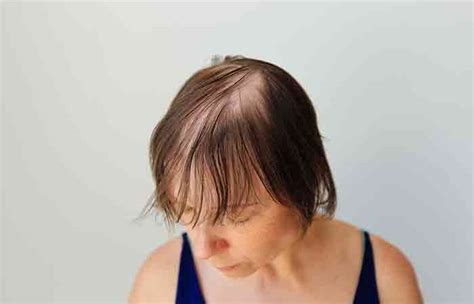 Genetics and Bald Spots: The Role of Heredity in Hair Loss