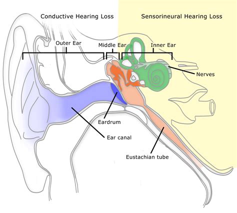 Hearing Loss or Damage in the Left Ear