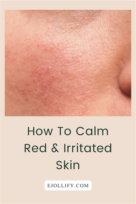 How to Soothe Red Cheeks and Prevent Discomfort