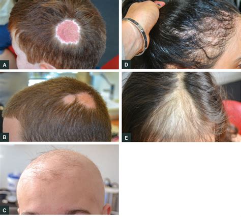 Identifying Early Signs of Hair Loss in Children