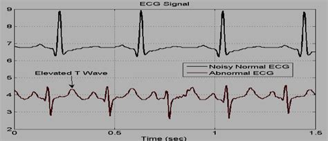 Identifying Normal vs. Abnormal ECG Readings