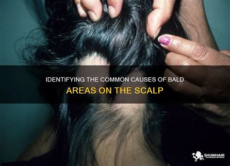 Identifying a Bald Patch on the Scalp: Causes and Symptoms