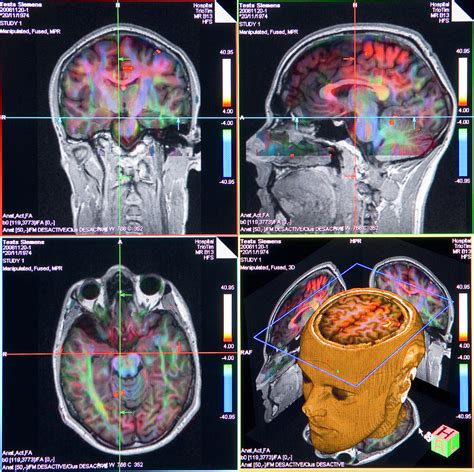 Imagining a World with Advanced Brain Transplant Technology