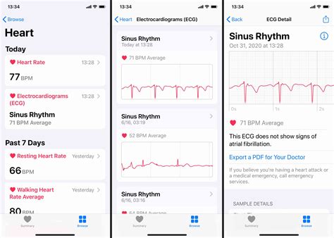 Interpreting ECG Results on Your Apple Timepiece