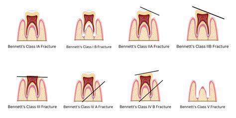 Interpreting the emotional impact of experiencing a fracture in a tooth in dreams