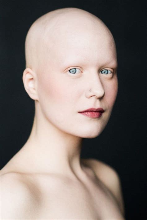 Investigating the Role of Gender in Dreams of a Bald Head