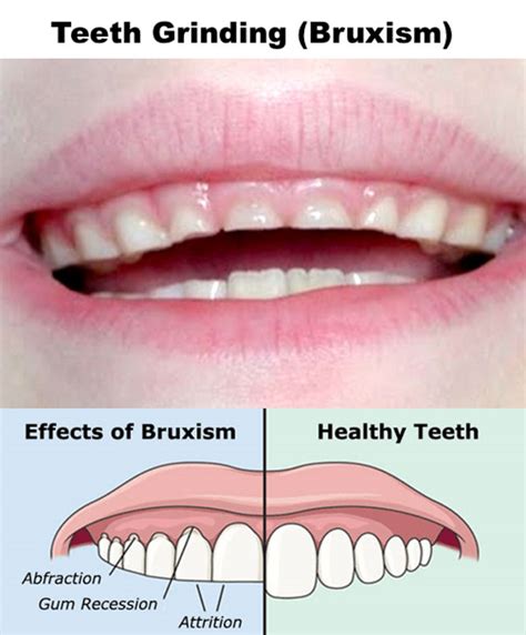 Link Between Oral Health Conditions and Bruxism in Children