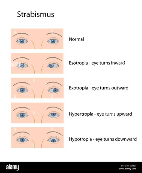 Living with Strabismus: Embracing Your Unique Perspective on the World