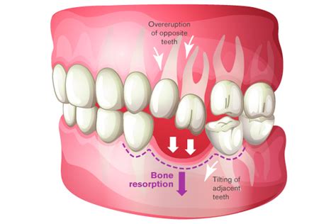 Long-Term Consequences of Tooth Loss