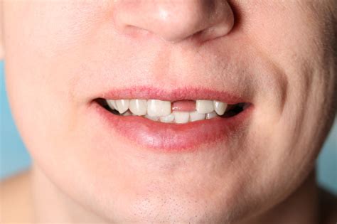 Loss of Power and Control: Uncovering the Meaning behind the Missing Front Tooth