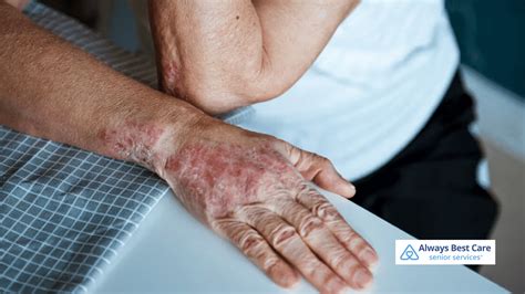 Managing Psoriasis Flare-ups: Helpful Tips and Tricks