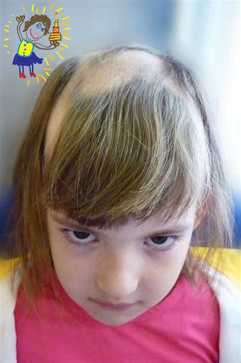 Medical Conditions That May Lead to Hair Loss in Children