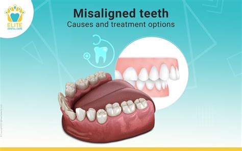 Methods to Overcome Anxiety and Fear Associated with Misaligned Teeth Nightmares