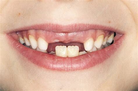 Natural Aging and Tooth Loss: Is it Normal?